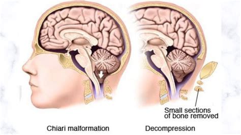 Chiari Malformation Type 1 - Health 24