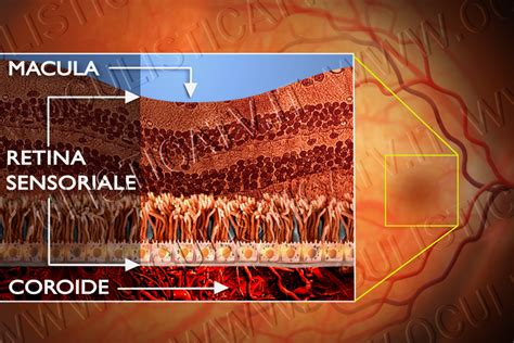 DISTACCO DI RETINA E TERAPIA CHIRURGICA OCULISTICATV