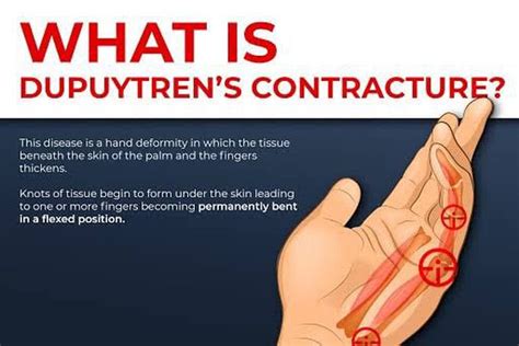 Dupuytren S Contracture Medizzy