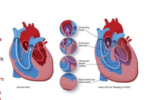 Peds Cardiology Flashcards Quizlet