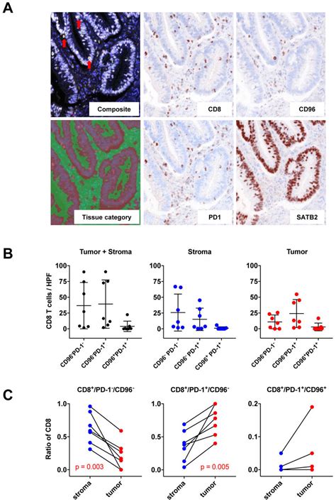 CD96 Immune Cell Infiltration In Microsatellite Unstable Colorectal