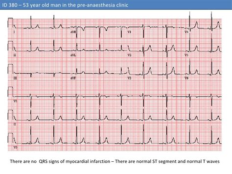 Ecg 1 Id 380 Normal Ecg