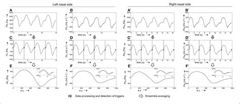 Figure 1 From Automatic Processing Of Nasal Pressure Recordings To