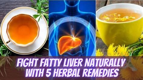 Fight Fatty Liver Naturally With 5 Herbal Remedies Easy Youtube