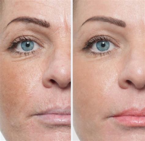 Title Microneedling Microneedling With PRP Vampire Facial