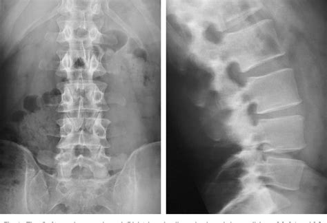 Figure 1 From Avascular Necrosis Of Lumbar Facet Joints Associated With