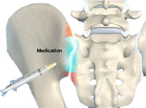 Sacroiliac Joint Pain - Rehab On The Road