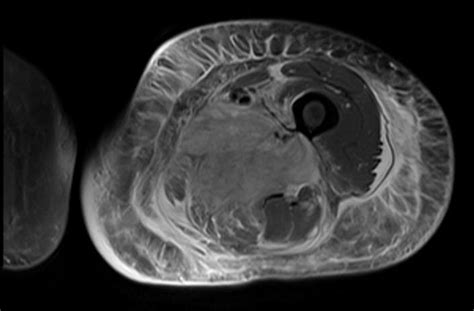 A Rare Complication of Diabetes: Diabetic Myonecrosis – Clinical ...