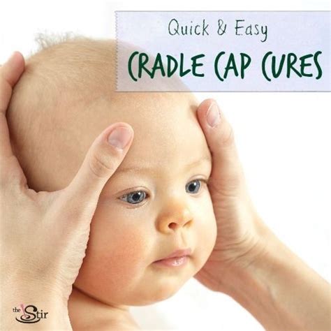 What Is The Best Treatment For Cradle Cap