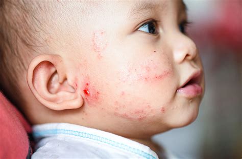 Kenali Gejala Munculnya Scabies Pada Bayi