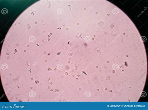 Urine Crystals, Red Blood Cells And Leukocytes At The Microscope. Urinary Tract Disease In Cat ...