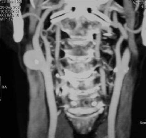 Angio Ct Scan Frontal View Of Carotid Axis Download Scientific Diagram