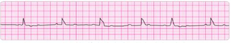 ACLS Precourse Self Assessment Flashcards Quizlet