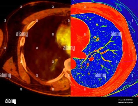 Ct Scan Of Chest Axial View In Color Mode For Diagnostic Pulmonary Embolism Pe Lung Cancer