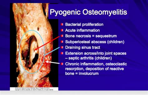 Bone Infections Flashcards Quizlet