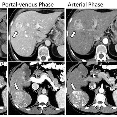 Lymph Node Drainage Patterns For Intrahepatic Cholangiocarcinoma Vary