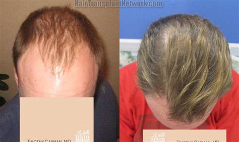 Dr Timothy Carman Hair Restoration Procedure Before And After Result