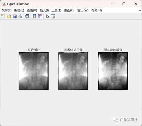 医学图像增强——基于同态滤波方法（matlab代码实现）同态滤波器matlab代码 Csdn博客