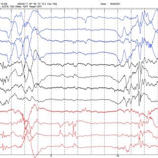 EEG of the patient showing the burst-suppression pattern. | Download Scientific Diagram