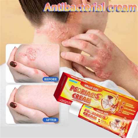 Sumifun Antibacterial Cream Psoriasis Eczema Dermatitis Fungal