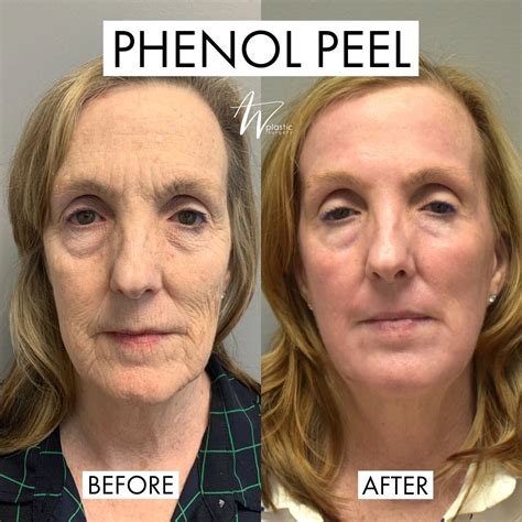 Collection Pictures Deep Chemical Peel Before And After Photos