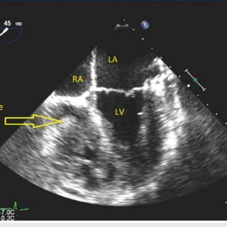 Transesophageal Echocardiogram Mid Esophageal View Showing A Clearer