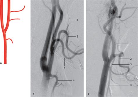 External Carotid Artery Branches Angiogram