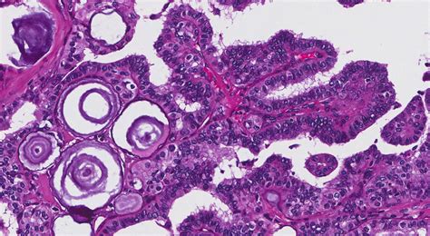 Psammom Körper Mypathologyreport Ca