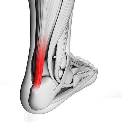 Cirurgia Tend O De Aquiles Procedimento Cir Rgico E Recupera O