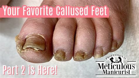 Extremely Callused Feet How To Pedicure Left Foot Youtube