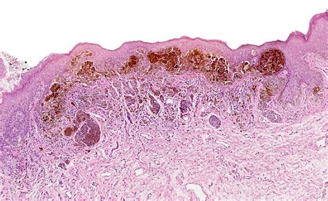 Pathology Outlines Atypical Melanocytic Nevi Of The Genital Type Vulva