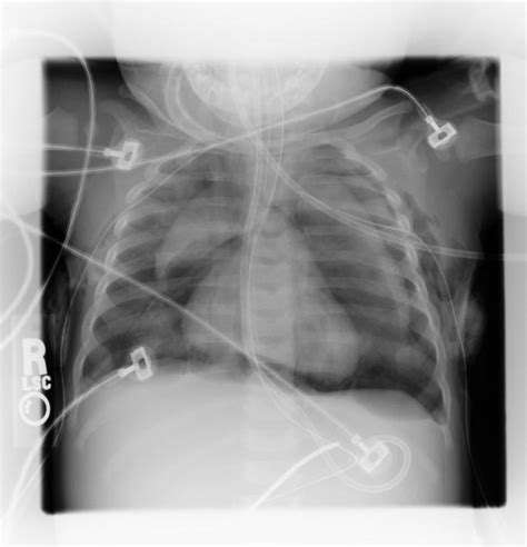 Mediastinal Emphysema; Emphysema, Mediastinal; Pneumomediastinum