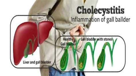 Cholecystitis | Getcured Apothecary Pvt Ltd- Part 2