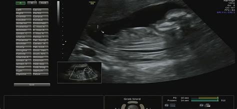 Early gender ultrasound | BabyCenter