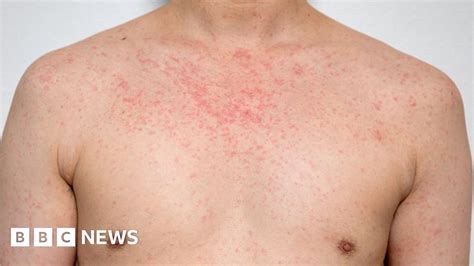 Health Leaders Raise Concern Over Measles Bbc News