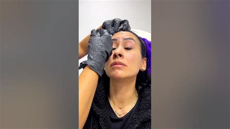 Mesoterapia Capilar Bogotá Para La Caída De Cabello Dermatóloga Y