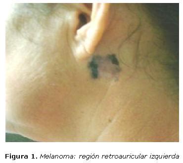 Melanoma maligno con metástasis cerebral Martín Pozo Acta Médica