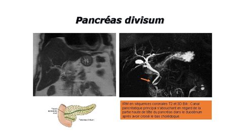 Radio Anatomie Normale Du Pancras Ses Variantes Et