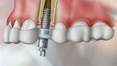 D Guided Implant Surgery Dentistree Dental Clinic