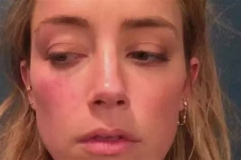 Amber Heard expõe fotos de agressão de Johnny Depp no tribunal VEJA