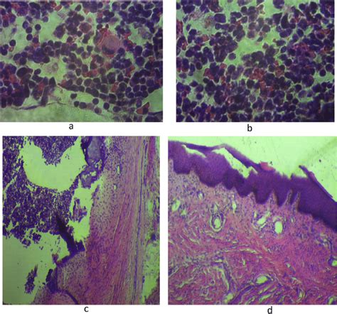 Histology A And B Show Sheets Of Immature Neuroepithelial Cells