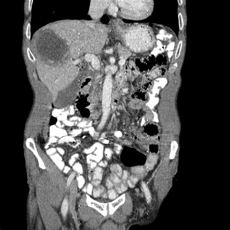 Hepatic Hydatid Cyst Image Radiopaedia Org