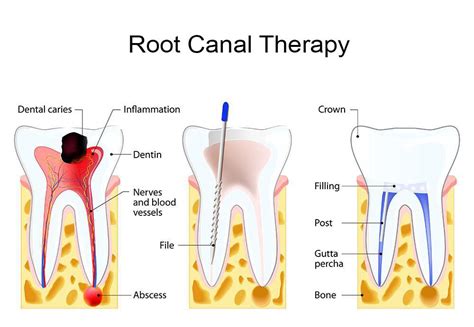 Root Canal Therapy