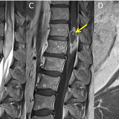 Spinal Cord Mri From Patient 3 Sagittal Stir Image Shows Multifocal