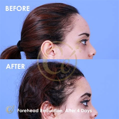 Forehead Reduction Dr Cengizhan Ekizceli