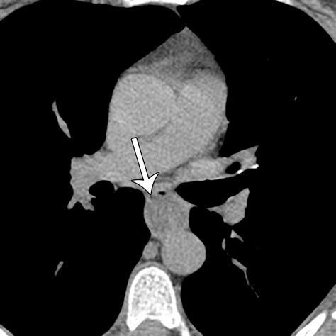 Bronchiolitis A Practical Approach For The General Radiologist