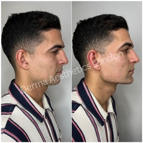 Jawline Filler Derma Aesthetics London