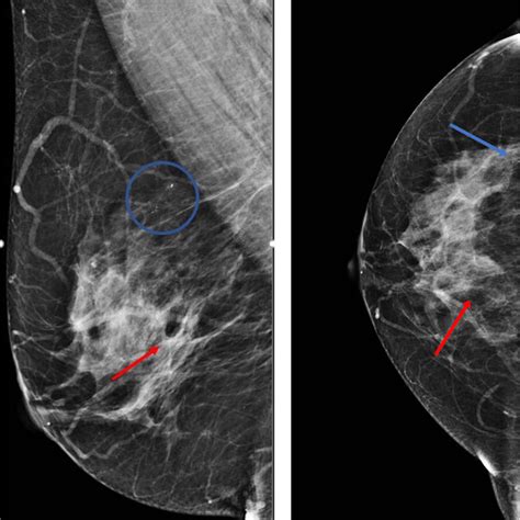 -Diagnostic mammogram with MLO view (A) and magnification view (B) from ...