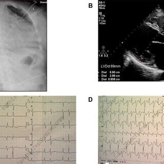 Image of case 1 (Figure 1:II-6). (A) Chest X-ray showed congestion with ...