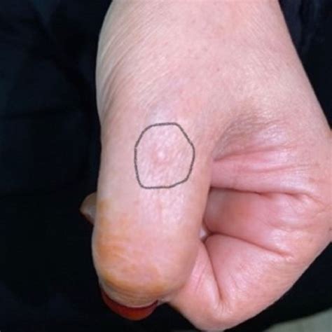 Figure Shows Skin Colored Papules On The Thumb Which Are Indurated And Download Scientific